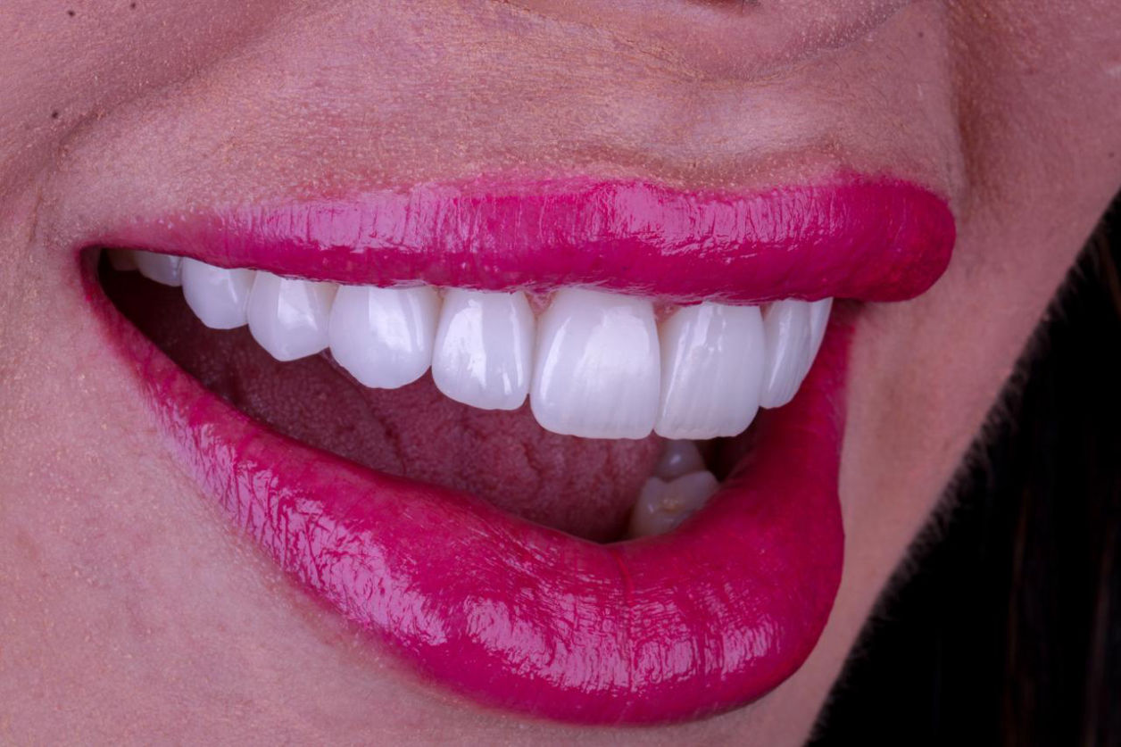 Sorriso com laminados cerâmicos, em fotografia de perfil